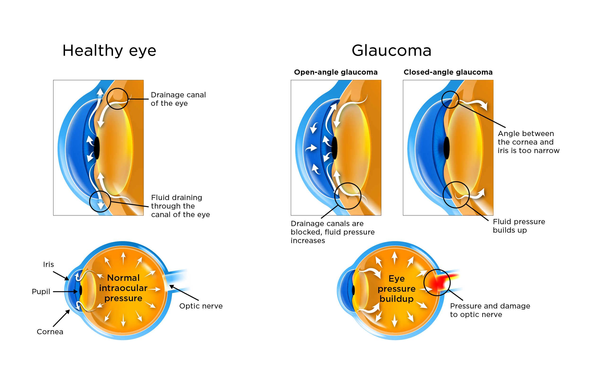 Can An Eye Doctor See Glaucoma